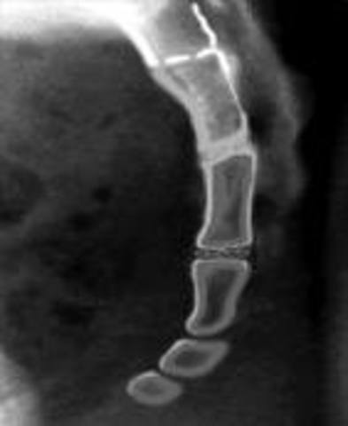 Fractured my tailbone