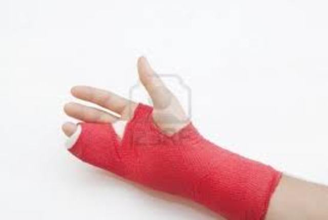 Broken hand