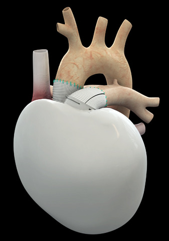 Η μικρότερη τεχνητή καρδιά στον κόσμο