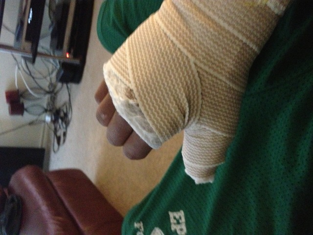 The Breaking of My Thumb