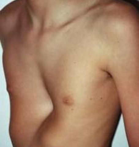 Diagnosed with pectus-excavatum
