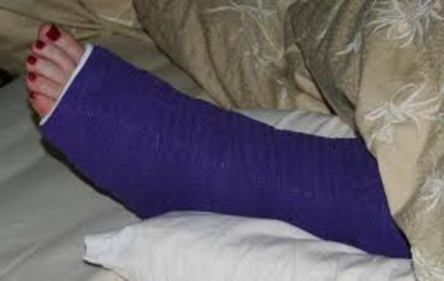 Broken Ankle