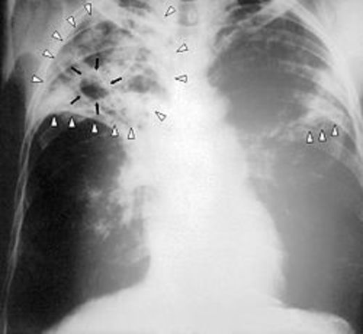 Contrae tuberculosis.
