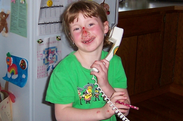 Nocked Out Two Front Teeth in Bike Accident