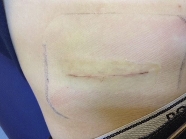 Had my Appendix out.