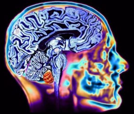 Huntington's Disease