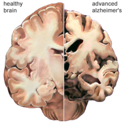 Timeline: The History of Alzheimer's disease