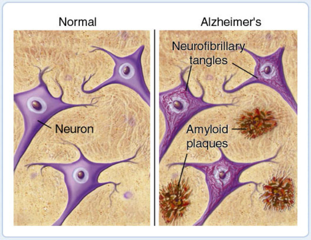 Beta-amyloid identified