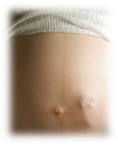 Prenatal (eighteen weeks)