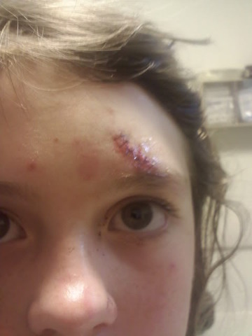 My first set of stitches