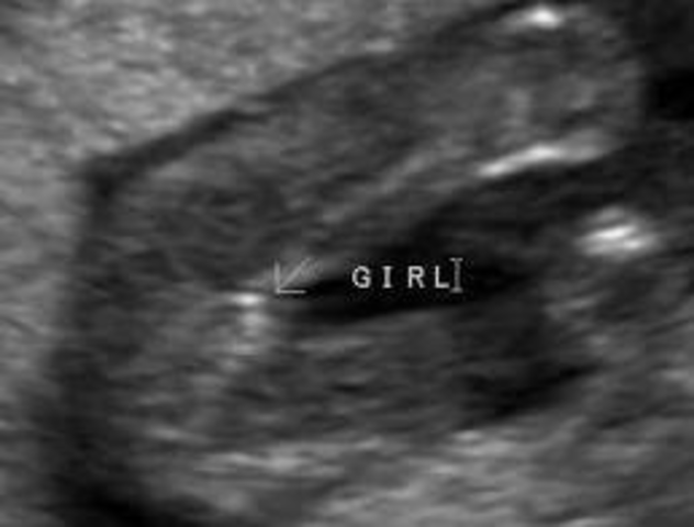 Prenatal #3 Sex of Baby Apparent