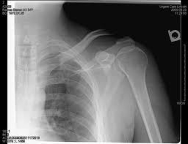 I broke My Collar Bone