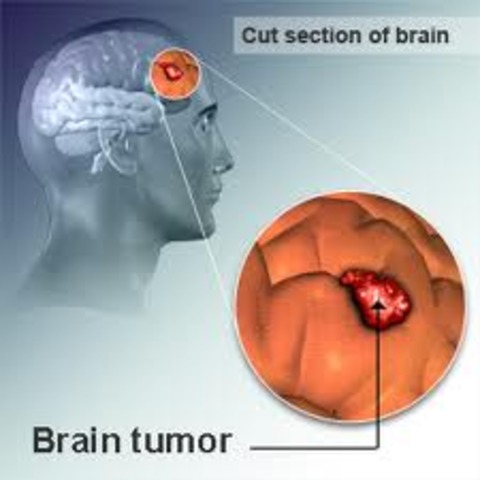 Breakthrough: Treat Malignant Childhood Brain Cancer