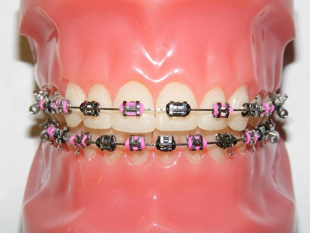 Braces