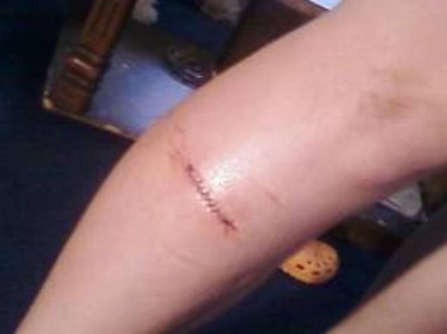stiches in mt leg