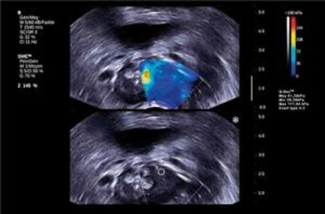 Invention of the Detection method elastography