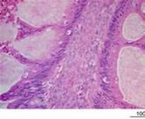 Breakthrough in Cnacer Research