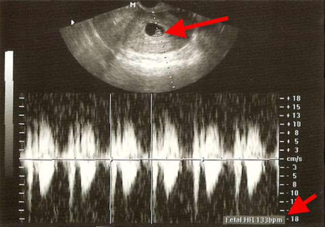 Prenatal - Heartbeat