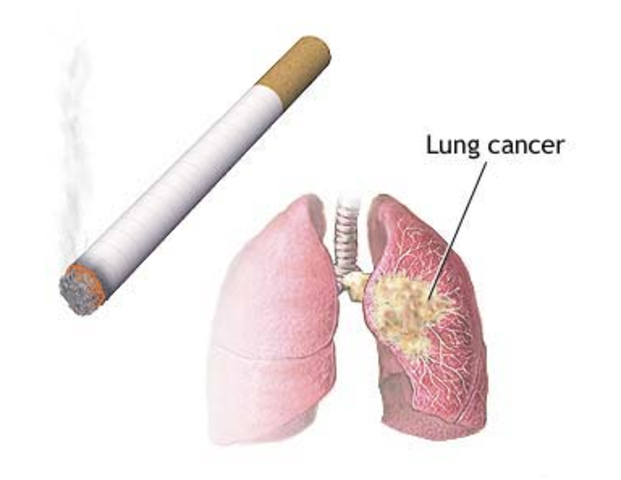 1929 Lung Cancer