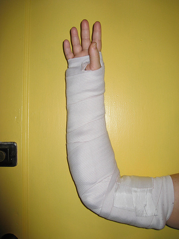 Breaking my arm