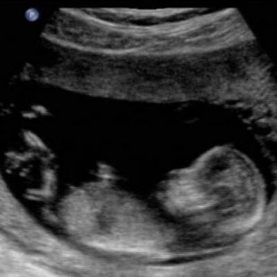 Timeline: Fetal Development