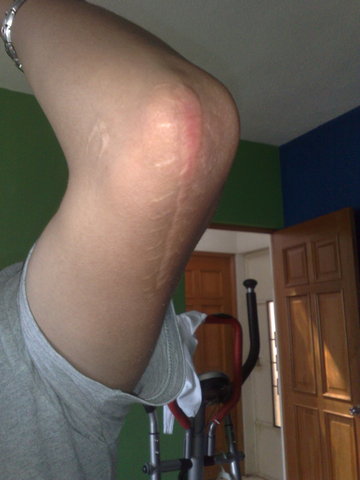 Me Quebré el Brazo...