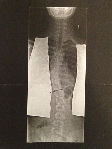 Discovering I have scoliosis