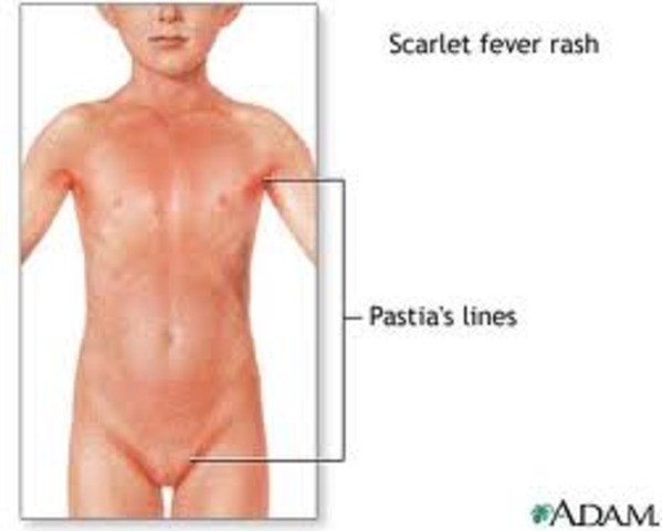 Scarlet Fever Becomes Less Severe
