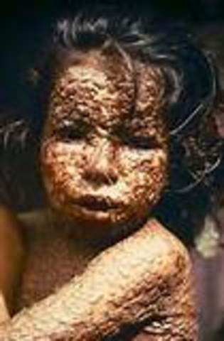 Small pox