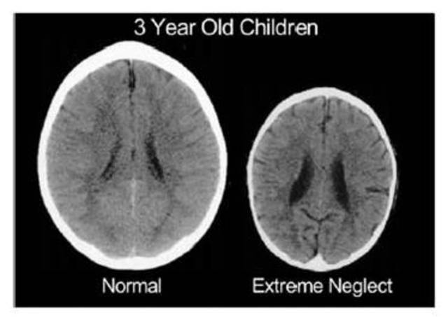Early Years- Brain Development
