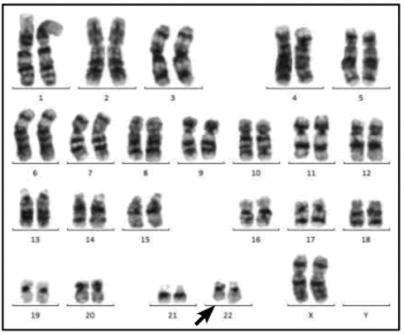 El cromosoma 22