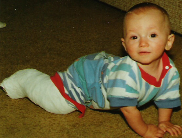 had surgery for club foot