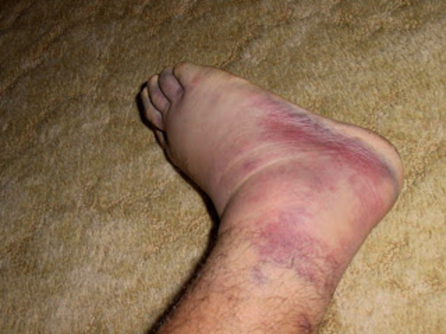 High Ankle Sprain