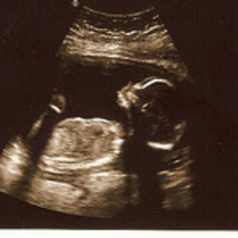 Prenatal-Middle of the Fetal Stage