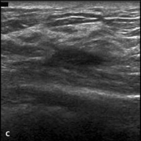 B-mode sonograms of breast tissue