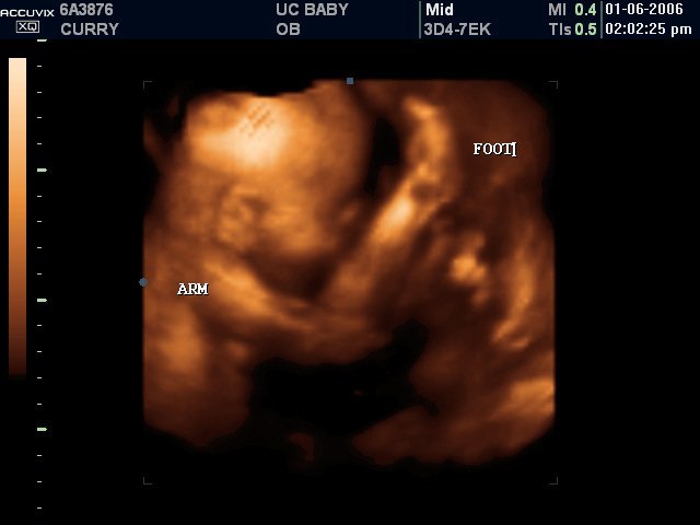 Development of 4-D (Real Time) / Ultrasound Progression