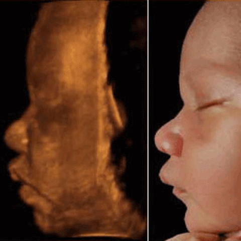 2D / 3D / 4D Ultrasound Today - Video