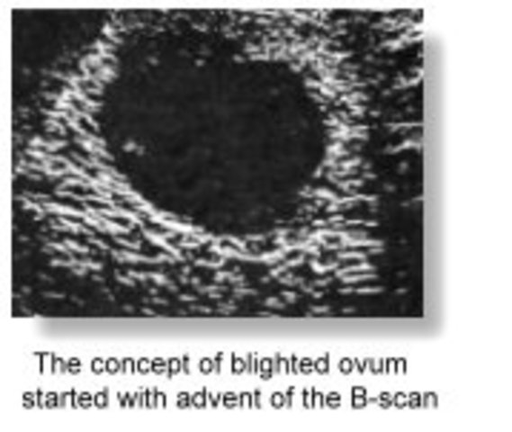Blighted Ovum