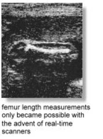 Femur Length