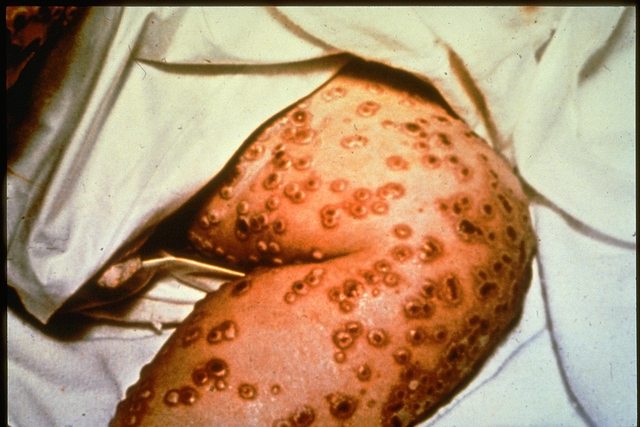 Smallpox