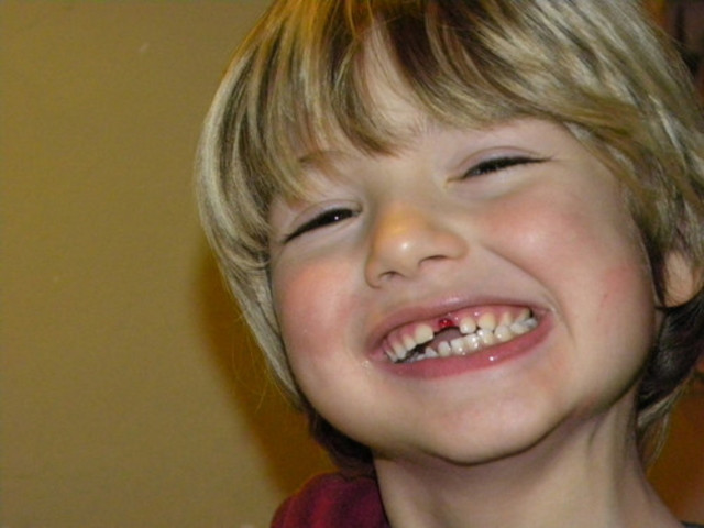 Caída del primer diente