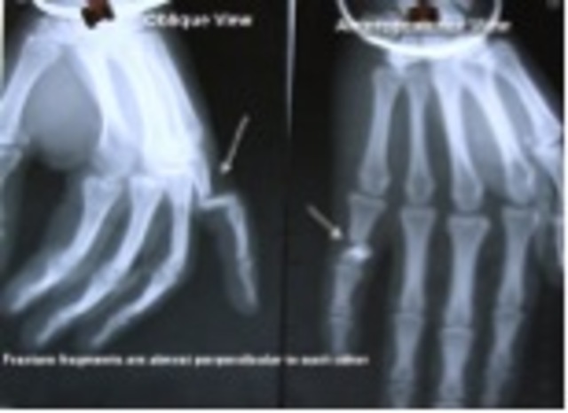 broke my pinkie finger