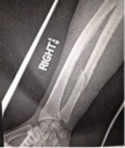 broke my right arm