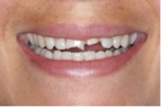 broke my front teeth