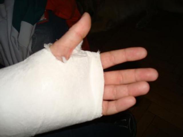 Me fracture el Braso