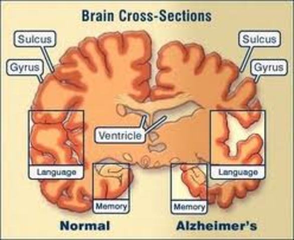 Onset of Alzheimer's