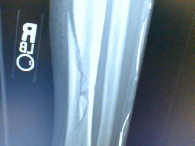 Breaking my leg