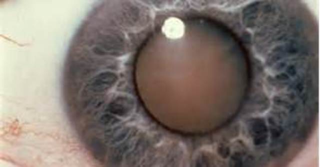 Cataract