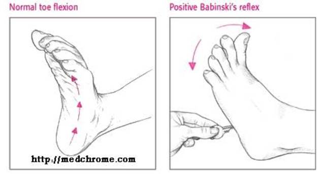 Babinski Reflex Disappears