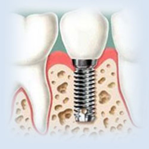 Implantes osteointegrados (biomaterial)